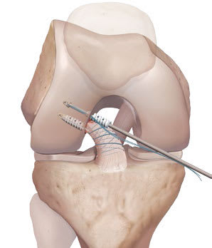 Réparation ou reconstruction du ligament croisé antérieur du genou ...