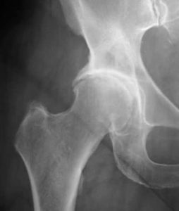 arthrose de la hanche arthrose de la hanche