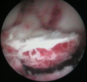 réinsertion des épines tibiales sous arthroscopie