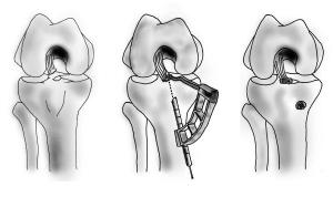 réinsertion des épines tibiales sous arthroscopie