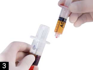 le PRP prêt à être injecté