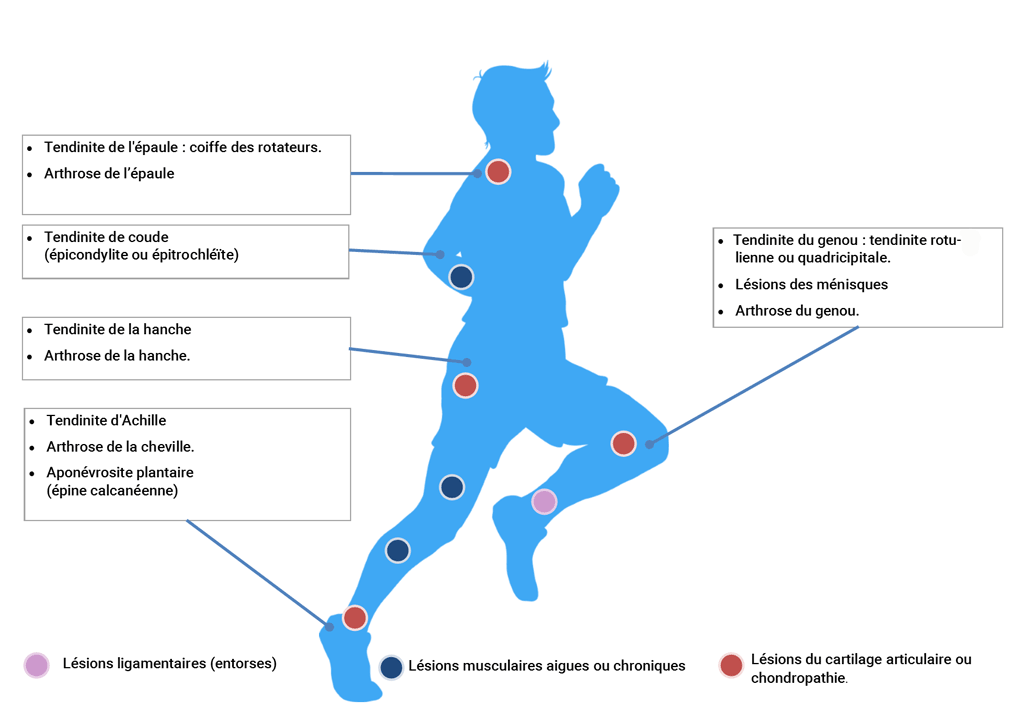 Les principales indications du traitement par injection de PRP Les principales indications du traitement par injection de PRP