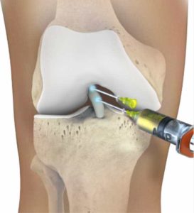 rupture partielle du ligament croisé antérieur : injection de PRP rupture partielle du ligament croisé antérieur : injection de PRP