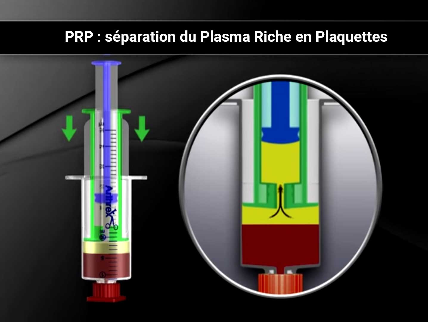 ’injections de Plasma Riche en Plaquettes