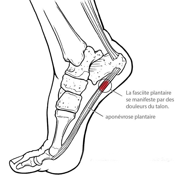 La fasciite plantaire se manifeste par des douleurs du talon.