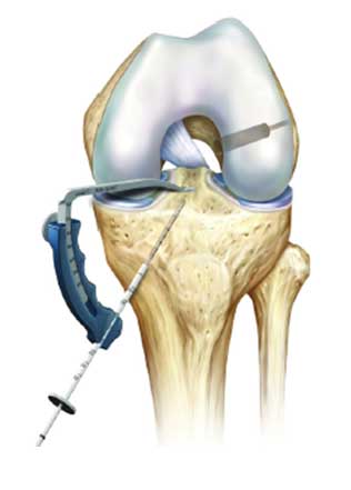 Techniques innovantes en chirurgie du genou : LCA Graftlink