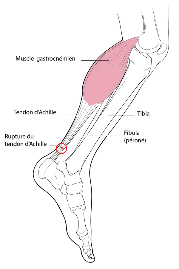 Rupture du talon d’Achille