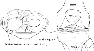 Lésions des ménisques