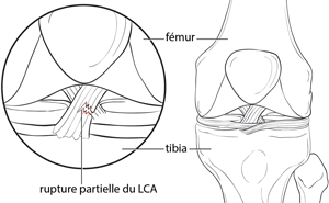 schéma rupture du ligament croisé antérieur-LCA