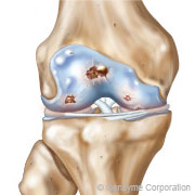 arthrose du genou de grade 3 arthrose du genou de grade 3