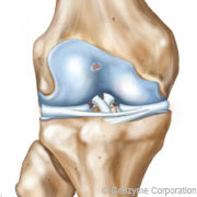 arthrose du genou – grade 1 arthrose du genou - grade 1
