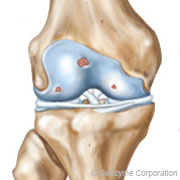 arthrose du genou de grade 2de2 arthrose du genou de grade 2