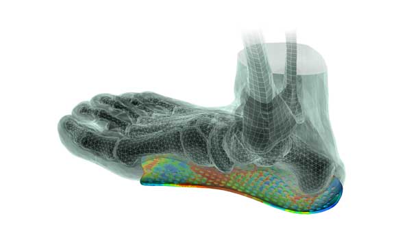 impression de semelles orthopédiques en 3D