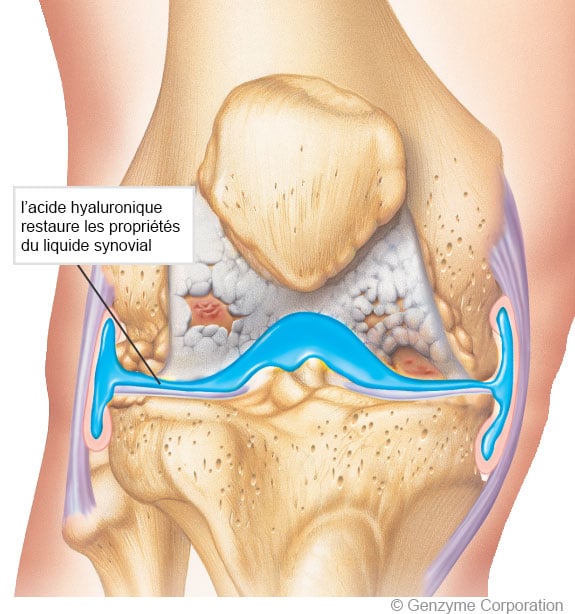 Douleur au genou : l'arthrose du genou en cause? - ZIO - Santé du