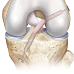 rupture du ligament croisé antérieur du genou