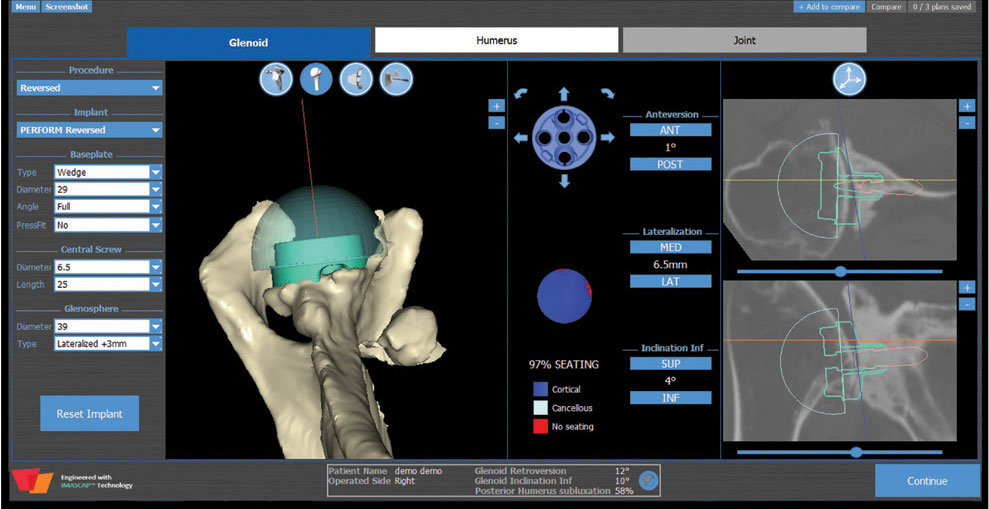 planification 3D prothèse d'épaule inversée
