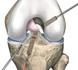 reconstruction du LCA technique DT4 GraftLink® - étape 4 : percement du tunnel tibial