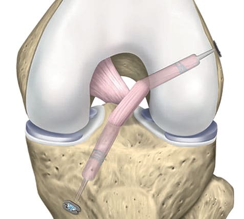 Réparation ou reconstruction du ligament croisé antérieur du genou ...