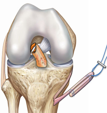 Réparation du LCA technique SAMBBA étape 2 suture du greffon