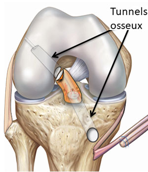 réparation du LCA SAMBBA étape 3 percement des tunnels fémoral et tibial