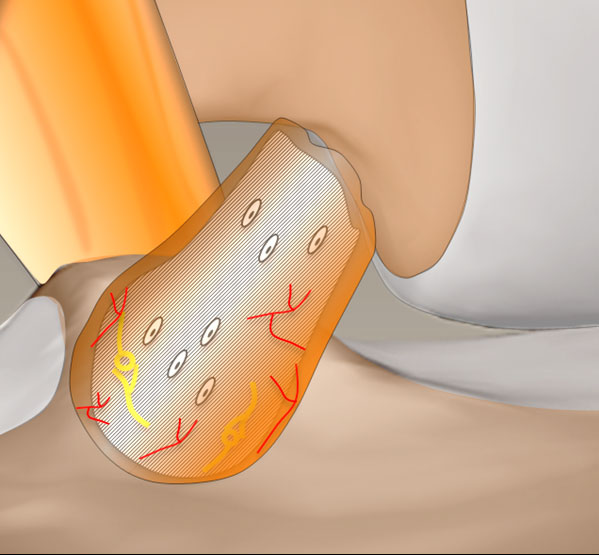 La technique LCA SAMBBA permet de conserver le rôle sensitif du ligament croisé antérieur