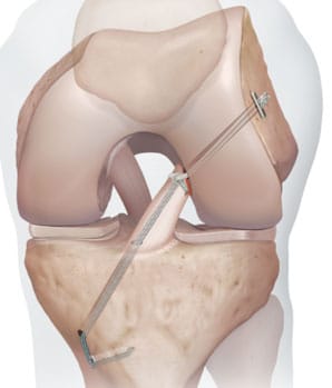 Le ligament croisé d'origine peut être renforcé par une bandelette de renfort InternalBrace