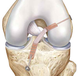 Dans la technique Kenneth-Jones, on prélève le tiers central du tendon rotulien avec une languette osseuse à chaque extrémité.