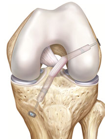 Dans la technique DT4, on prélève le tendon du muscle demi-tendineux (DT) qui est replié en 4 et tressé pour obtenir un greffon de diamètre suffisant