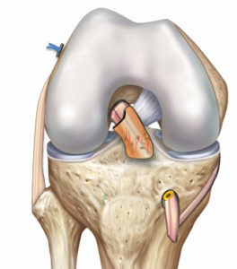 reconstruction-du-lca-technique-sambba Avec la technique LCA SAMBBA ( Single Antero Medial Bundle Biological Augment) on prélève le également le tendon du muscle demi-tendineux (DT) mais, à la différence de la technique DT4, le tendon n’est pas détaché du tibia.