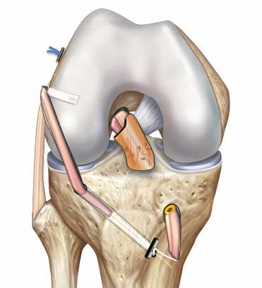 La technique LCA + LAL consiste à ajouter un renfort latéral constitué d’un greffon prélevé sur le tendon droit interne (DI) qui sera fixé entre le fémur et le tibia