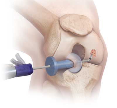 technique de microfractures ou perforations de Pridie pour traiter l'arthrose du genou