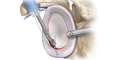 opération de Bankart sous arthroscopie