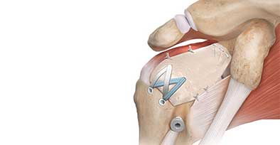 Réparation des tendons de la coiffe des rotateurs de l'épaule