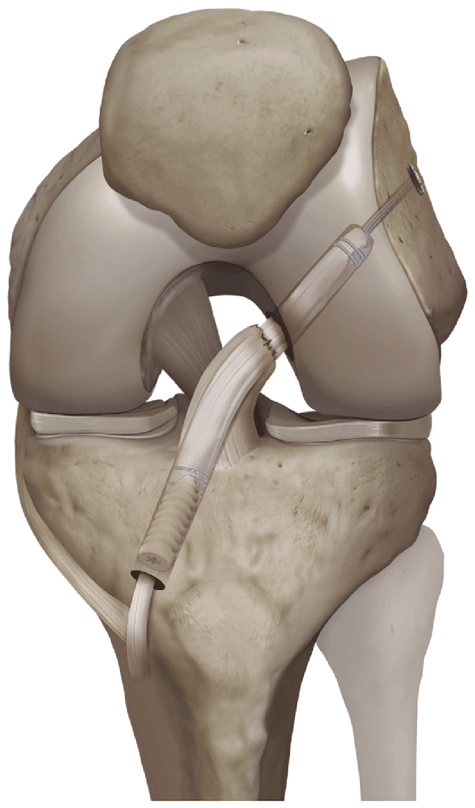 Réparation ou reconstruction du ligament croisé antérieur du genou ...