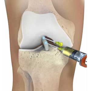 rupture partielle du ligament croisé antérieur : injection de PRP