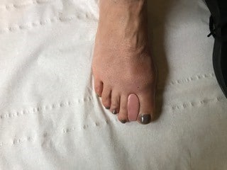 Une orthoplastie en silicone est réalisée le jour même par un podologue spécialisé