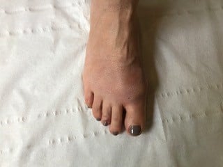 consultation à J+15 pour contrôler la bonne cicatrisation de la peau.