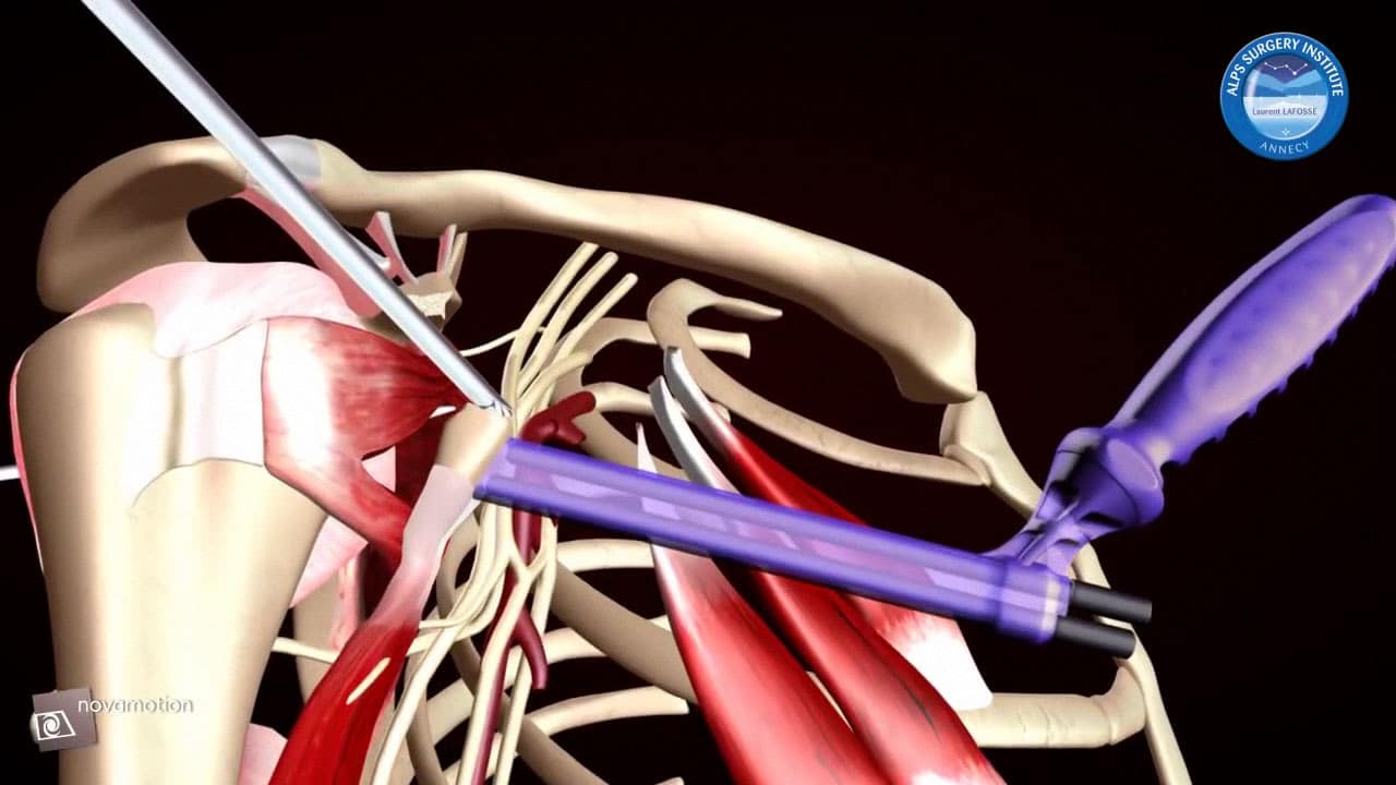 Butée d'épaule sous arthroscopie Latarjet.
