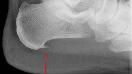 radiographie d'une épine-calcanéene