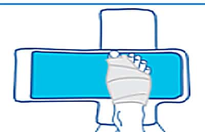 Utiliser le chausson de cryothérapie hallux valgus Igloo® : étape 1