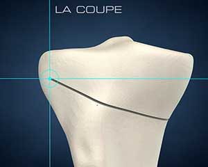 ostéotomie tibiale : coupe ostéotomie tibiale : coupe