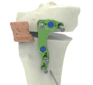 ostéotomie tibiale: plaque de fixation ostéotomie tibiale de valgisation : plaque de fixation