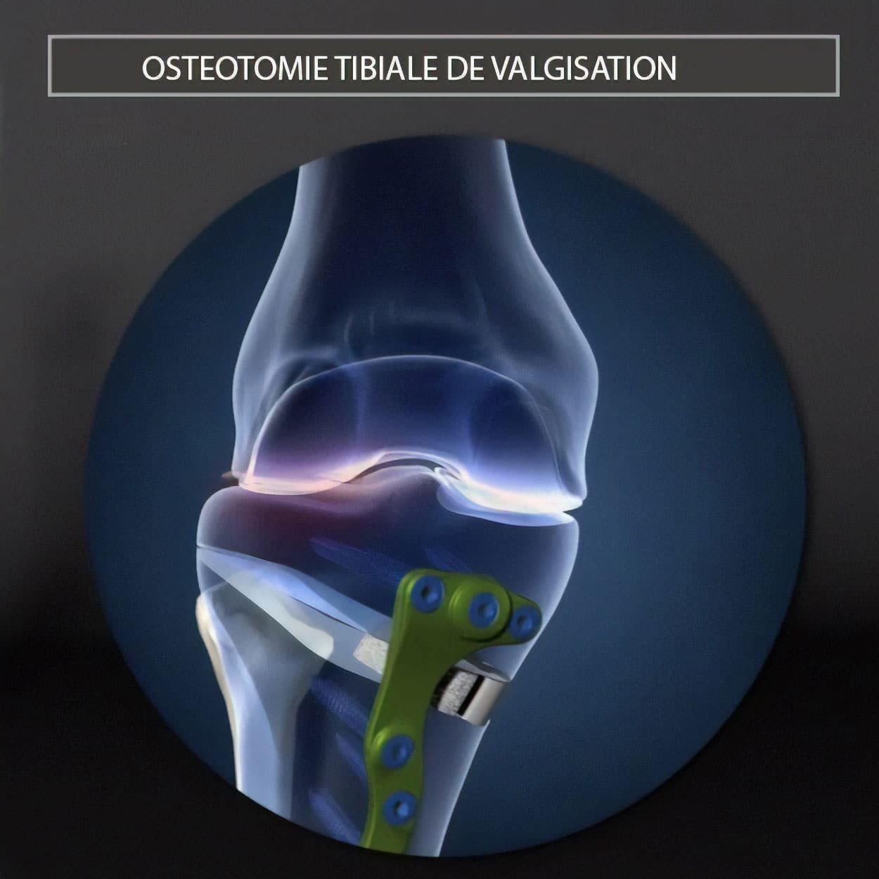 Ostéotomie tibiale de valgisation sur mesure