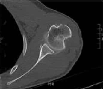 Encoche de Malgaigne ou de Hill-Sachs, fracture impaction de la partie postérieure de la tête humérale sur le rebord glénoïdien antérieur.