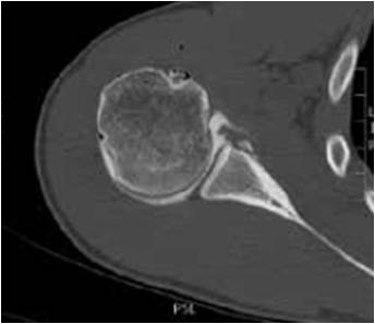 lésion de Bankart, avulsion capsulo-labrale du bord antéro-inférieur de la glène