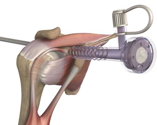 Ténotomie de la longue portion du tendon du biceps