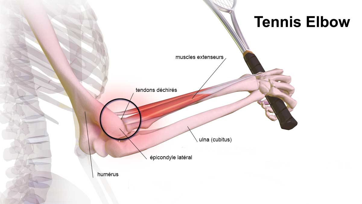 tennis elbow ou épicondylite latérale
