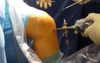 chirurgie arthroscopique du genou
