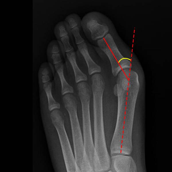 Hallux valgus, déformation du gros orteil