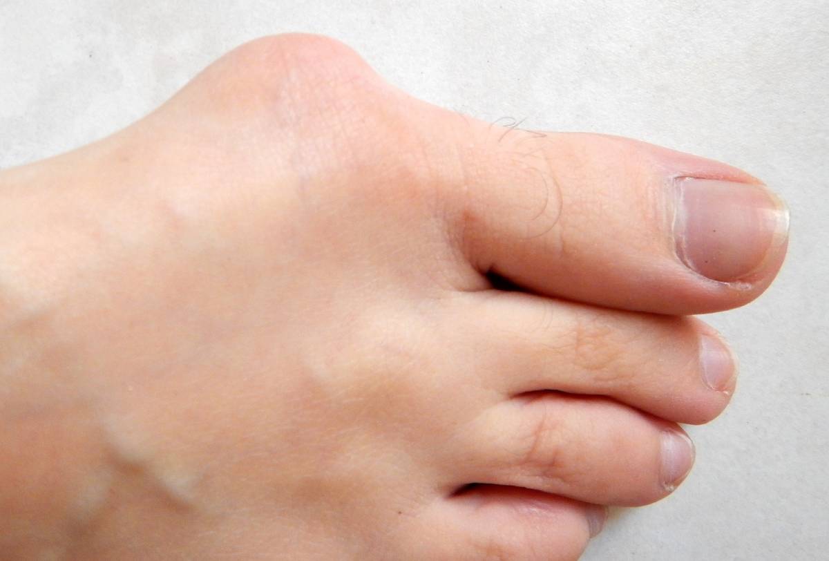 L’hallux valgus se caractérise par une bosse appelée oignon à la base du gros orteil.